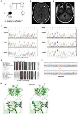 Ataxia with oculomotor apraxia type 2 caused by a novel homozygous mutation in SETX gene, and literature review